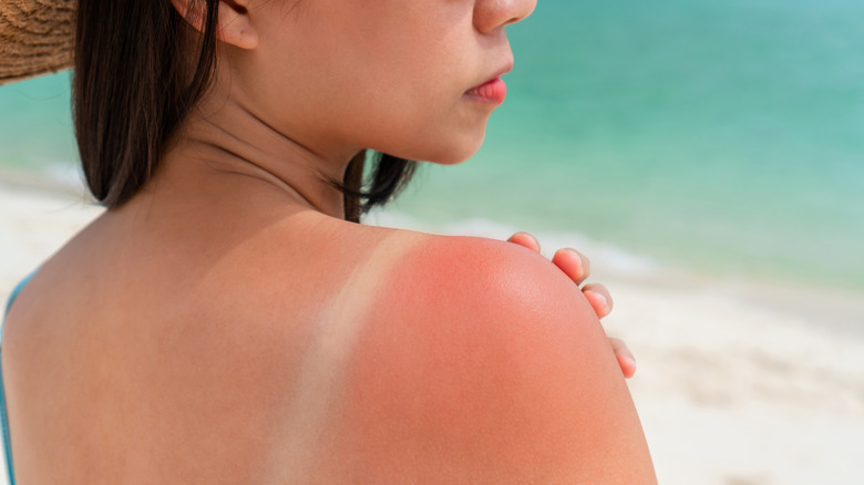 Woman's red shoulder with sunburn on faded beach background