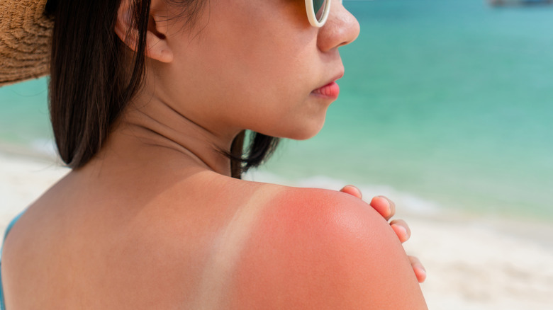 Sunburned skin on shoulder of a woman because of not using cream with sunscreen protection.