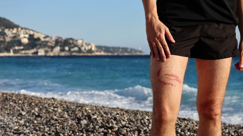 man with jellyfish sting on beach