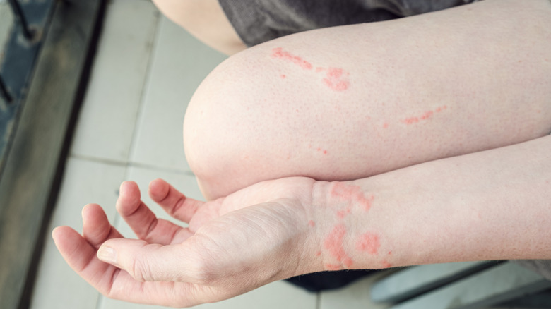 painful jellyfish sting on arm and leg
